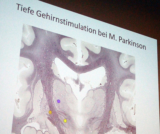 Parkinson - Info-Tage 2016